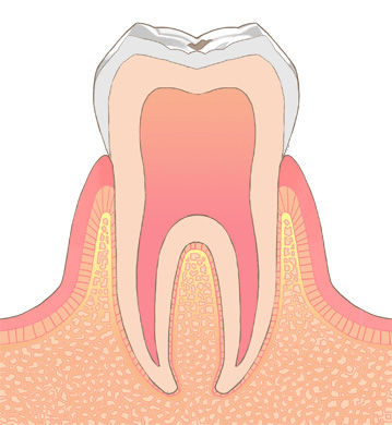 初期むし歯