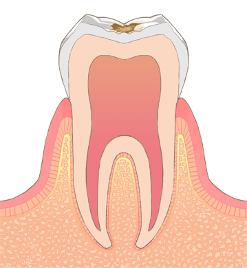 エナメル質う蝕