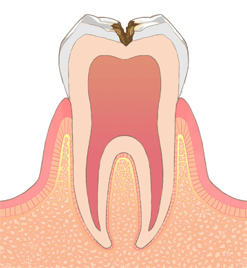 象牙質う蝕