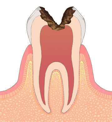 神経まで達したむし歯