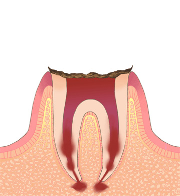 残痕状態のむし歯